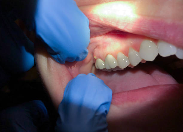 Best Urgent Tooth Repair  in Sandoval, IL